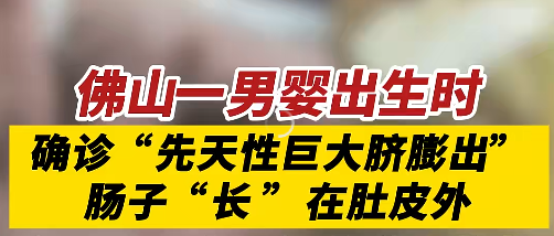 佛山一男婴出生时，肠子“长”在肚皮外